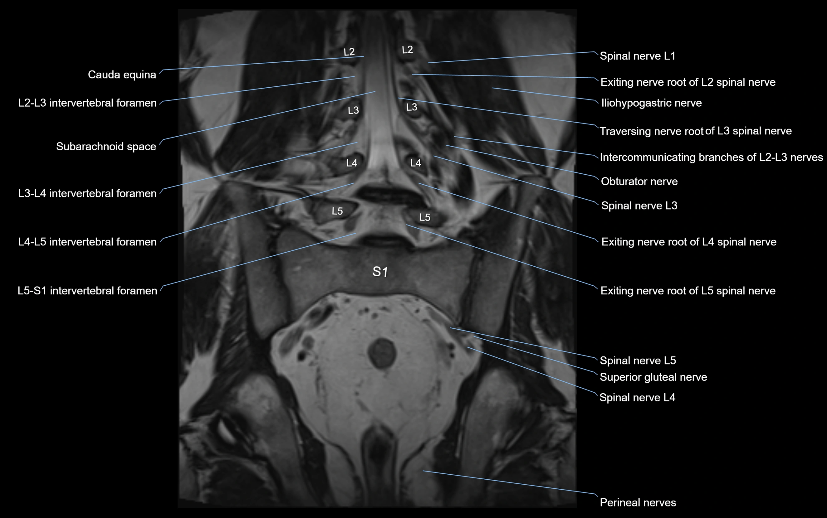 MR lumbosacral plexus cross sectional anatomy 3T  radiology  image-img-09001-00040.webp